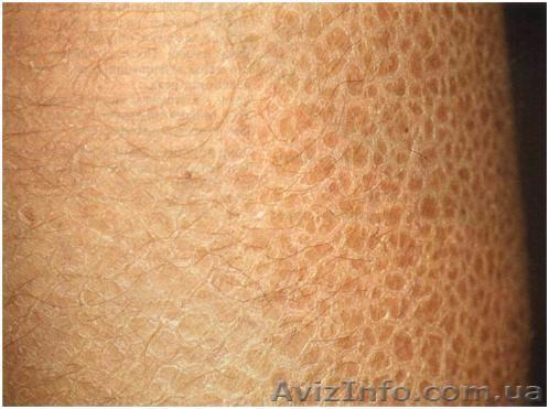 Средство от ихтиоза  - <ro>Изображение</ro><ru>Изображение</ru> #1, <ru>Объявление</ru> #182664